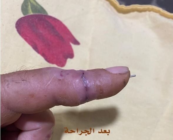 فريـق جراحـة بالمنوفيـة ينجـح فـي إعـادة توصيـل أصابـع مبتـورة و عودتهـا للحركـة
