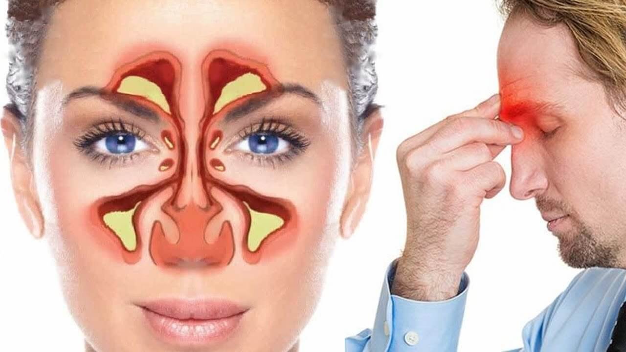 حبوب الجيوب الانفية علاج الجيوب الأنفية في المنزل اعراض التهاب الجيوب الانفية التهاب الجيوب الانفية علاج الجيوب الانفية صداع الجيوب الأنفية الجيوب الانفية اعراض الجيوب الانفية 