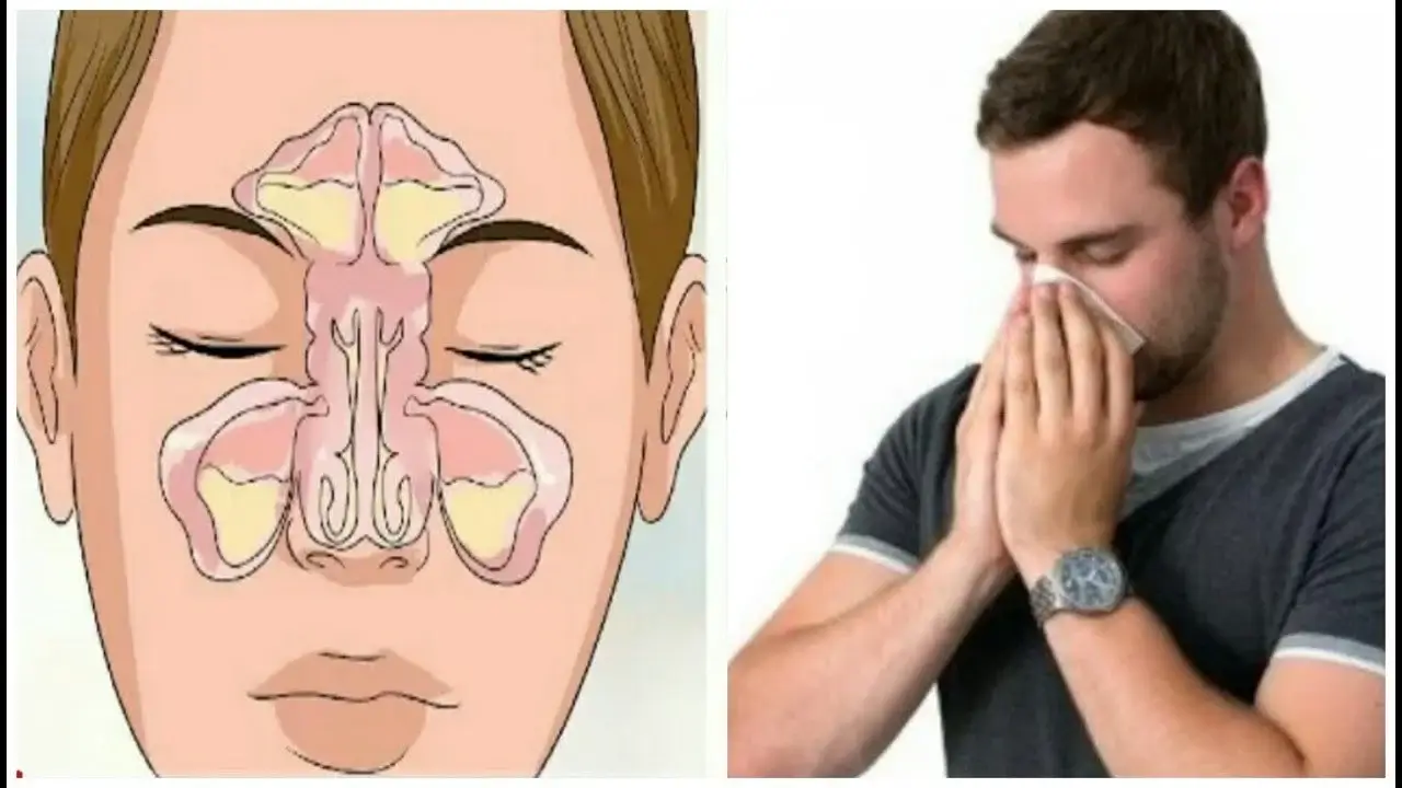 حبوب الجيوب الانفية علاج الجيوب الأنفية في المنزل اعراض التهاب الجيوب الانفية التهاب الجيوب الانفية علاج الجيوب الانفية صداع الجيوب الأنفية الجيوب الانفية اعراض الجيوب الانفية 