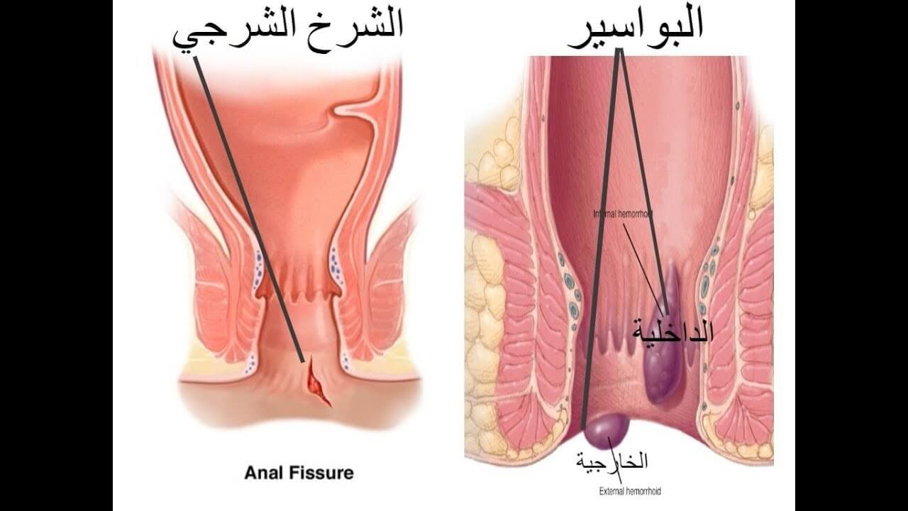 علاج البواسير الداخلية في المنزل ماهو علاج البواسير الخارجية عند النساء علاج البواسير الداخلية 